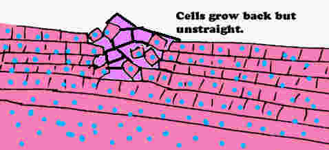 Cells healed back but not straight, leaving ugly scar.