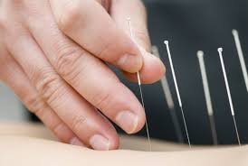 acupuncture.jpg (5903 bytes)